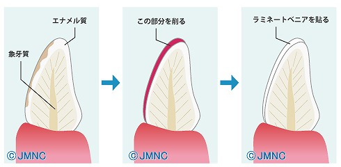 ラミネートべニア