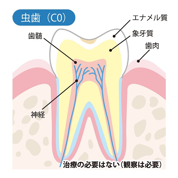 C0【ごく初期の虫歯】