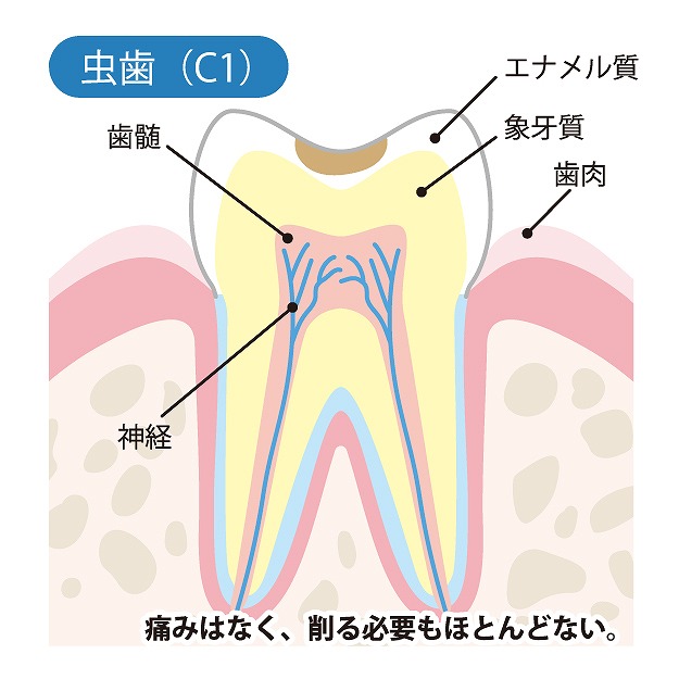 C1【エナメル質の虫歯】