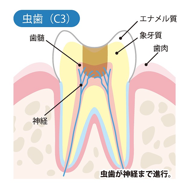 C3【神経まで達した虫歯】