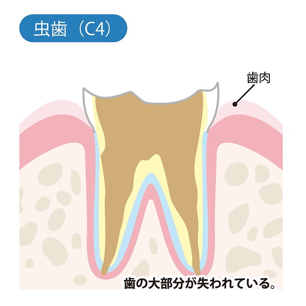 C4【歯根まで達した虫歯】