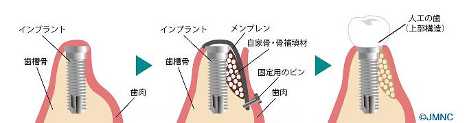 骨誘導再生法（GBR法）