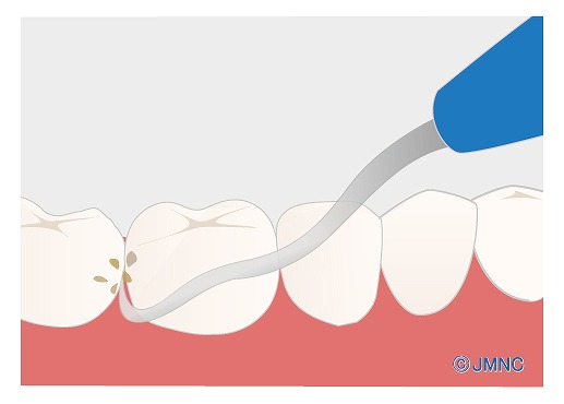SRP（歯石除去）