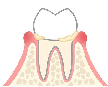 歯肉炎