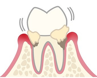 軽度歯周炎