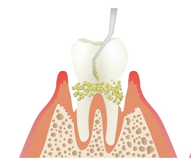 歯石取り（スケーリング）
