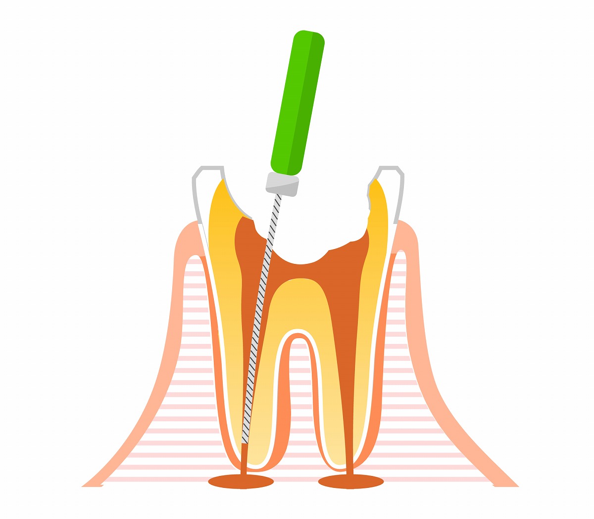 根管治療とは