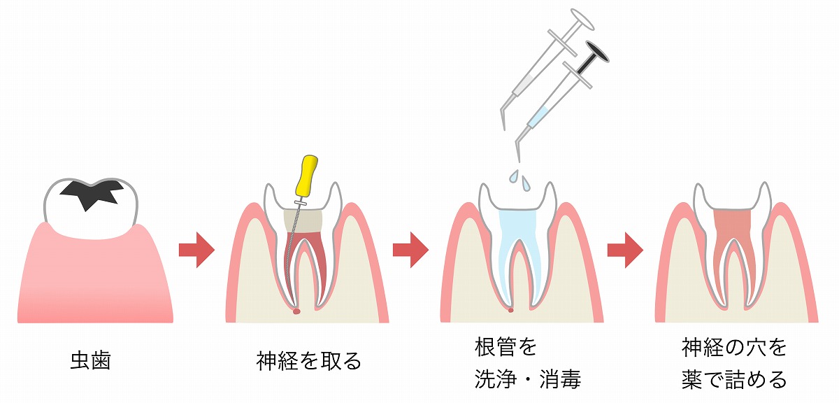 根管治療の流れ